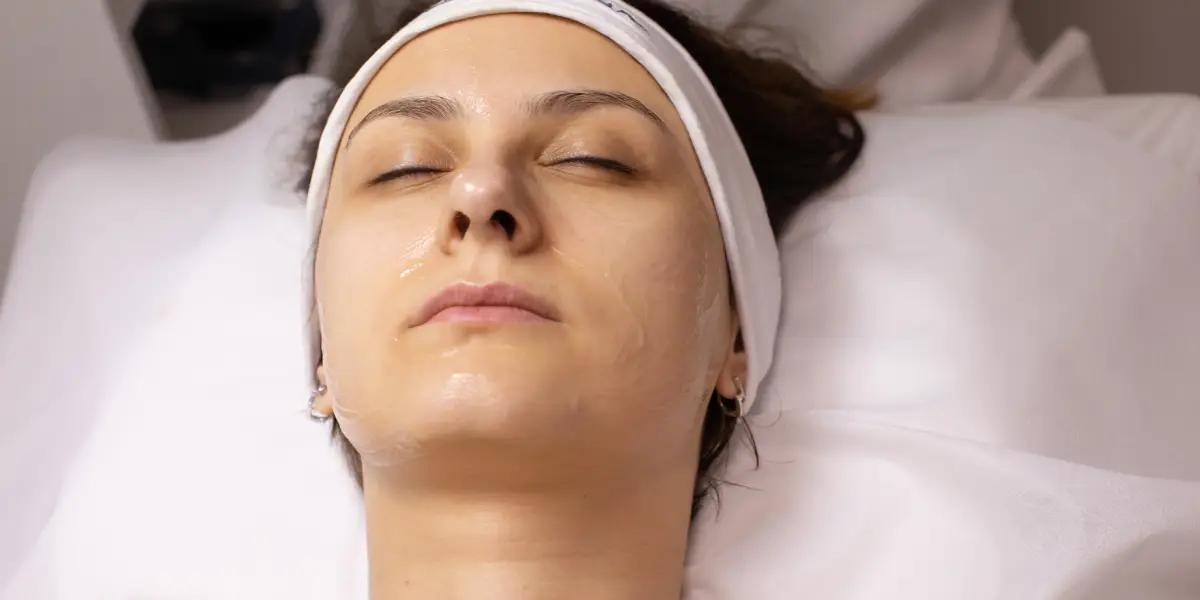 Chemical Peel treatment for acne scars and pigmentation at Create Medical Aesthetics