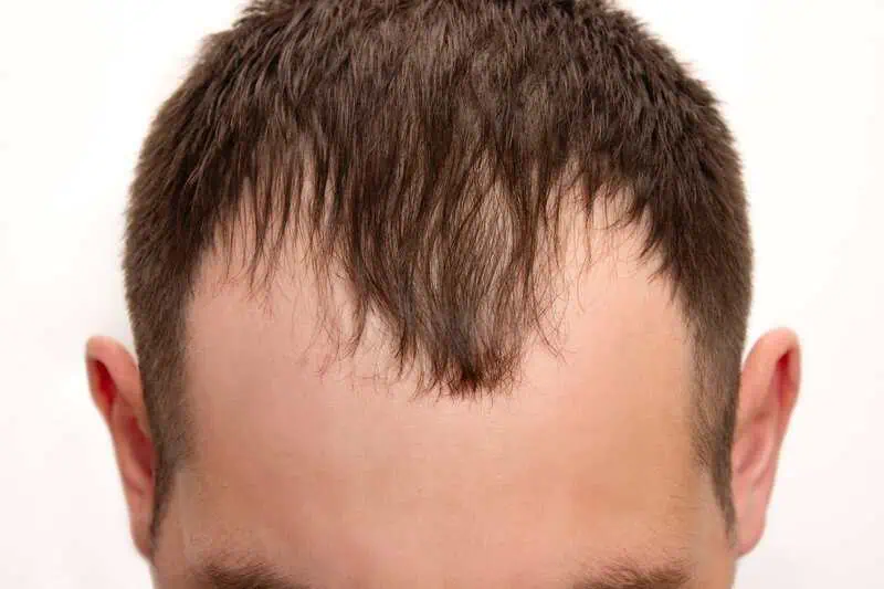 PRP Hair Restoration